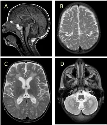 A novel missense mutation in ISCA2 causes aberrant splicing and leads to multiple mitochondrial dysfunctions syndrome 4